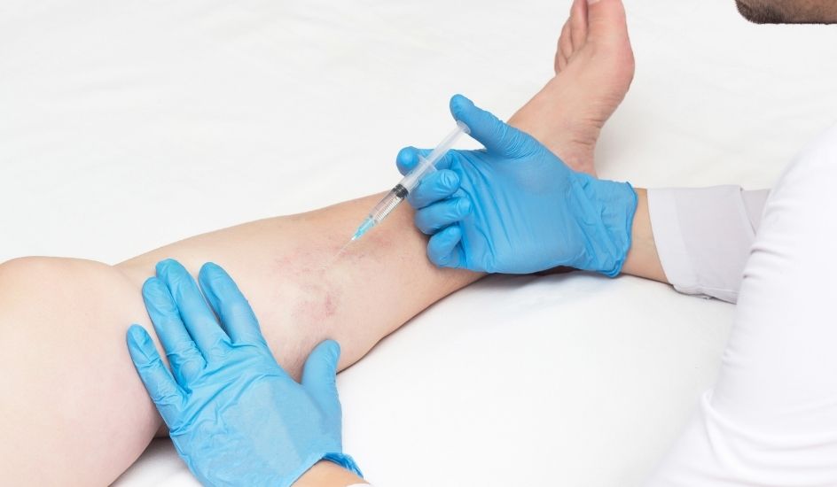 Sclerotherapy