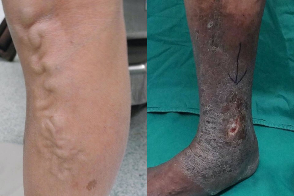 varicose veins complications