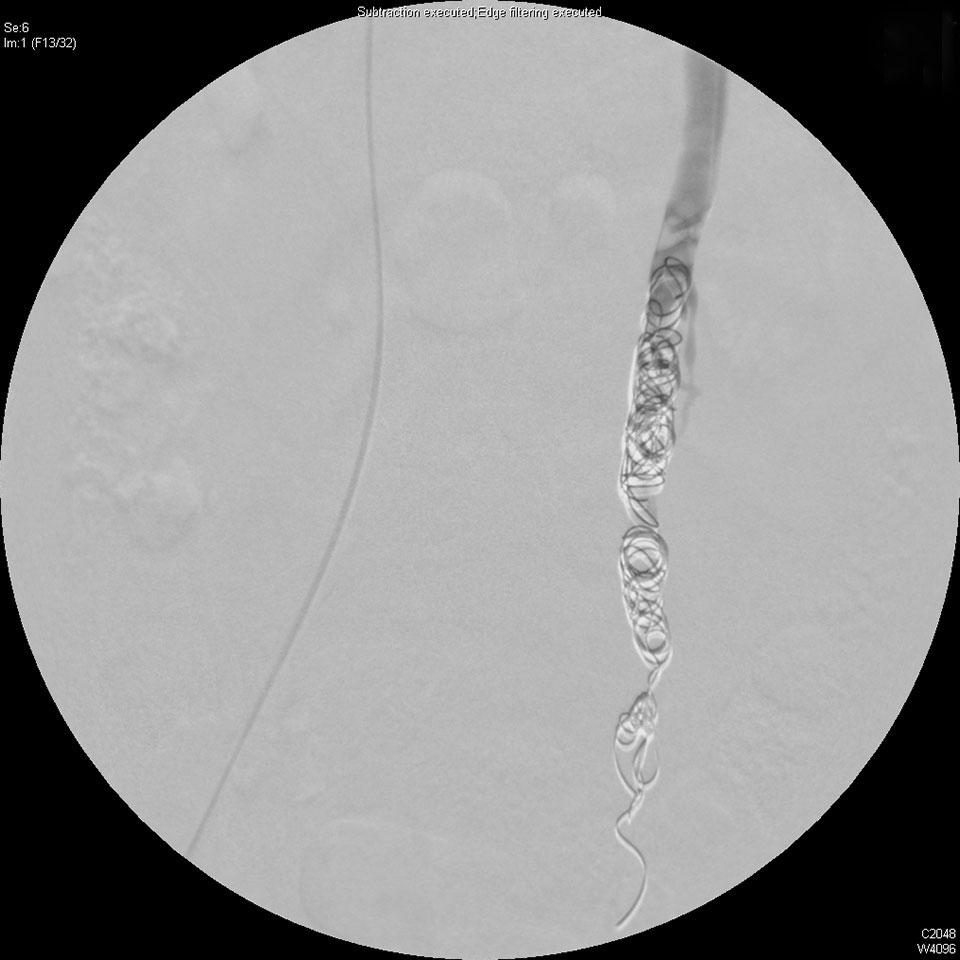 The vascular surgeon will embolize the left ovarian vein.