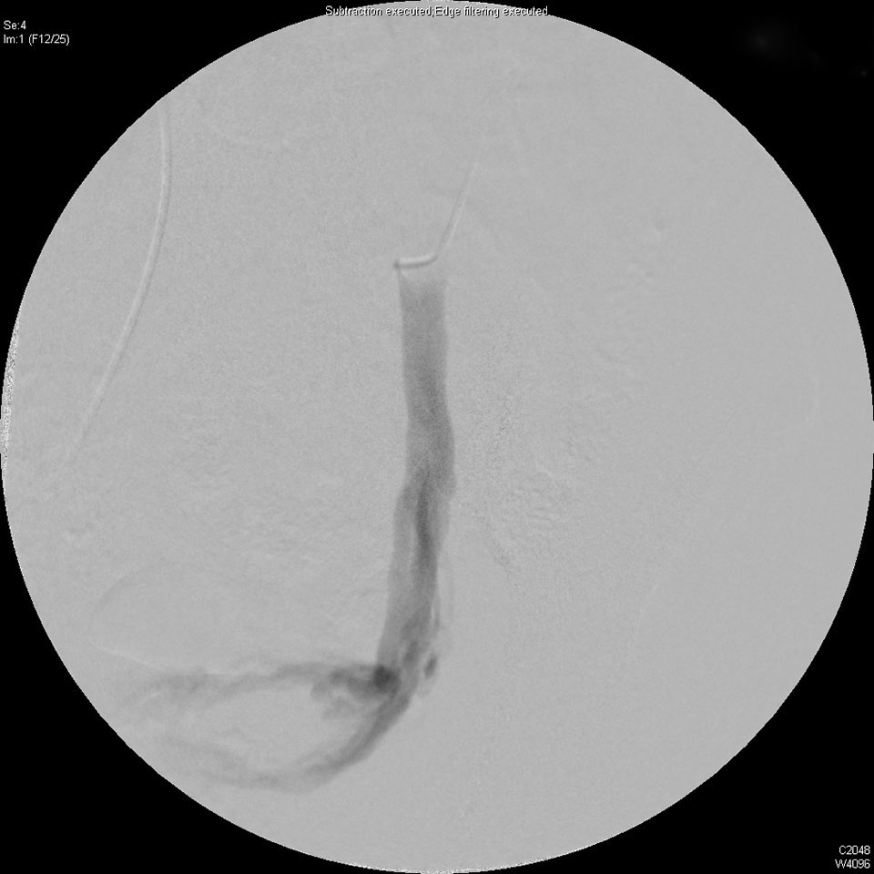 The refluxing left ovarian vein fills the pelvic veins.